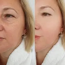 Morpheus8: cuando la tecnología se convierte en un ritual para la piel